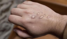 官员警告危险的新猴痘病毒将“跨境感染”