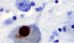 在帕金森氏症中，痴呆症的发生频率可能比以前认为的要低，或者要晚