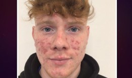 粉刺毁了年轻人的信心，直到不可思议的转变