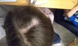 英国11岁小女孩被售票机咬掉头发，秃了一个斑点